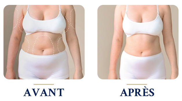 Avant - Après