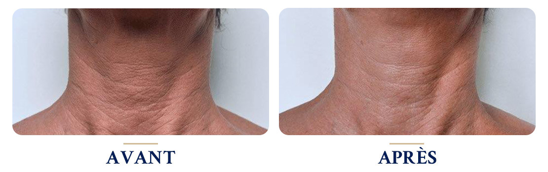 Avant / Après