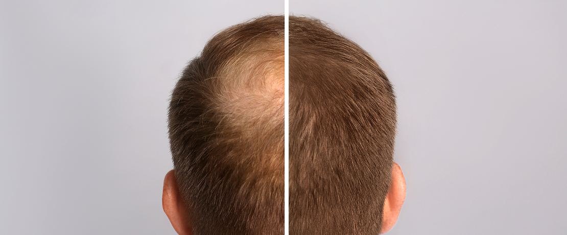 Micropigmentation capillaire